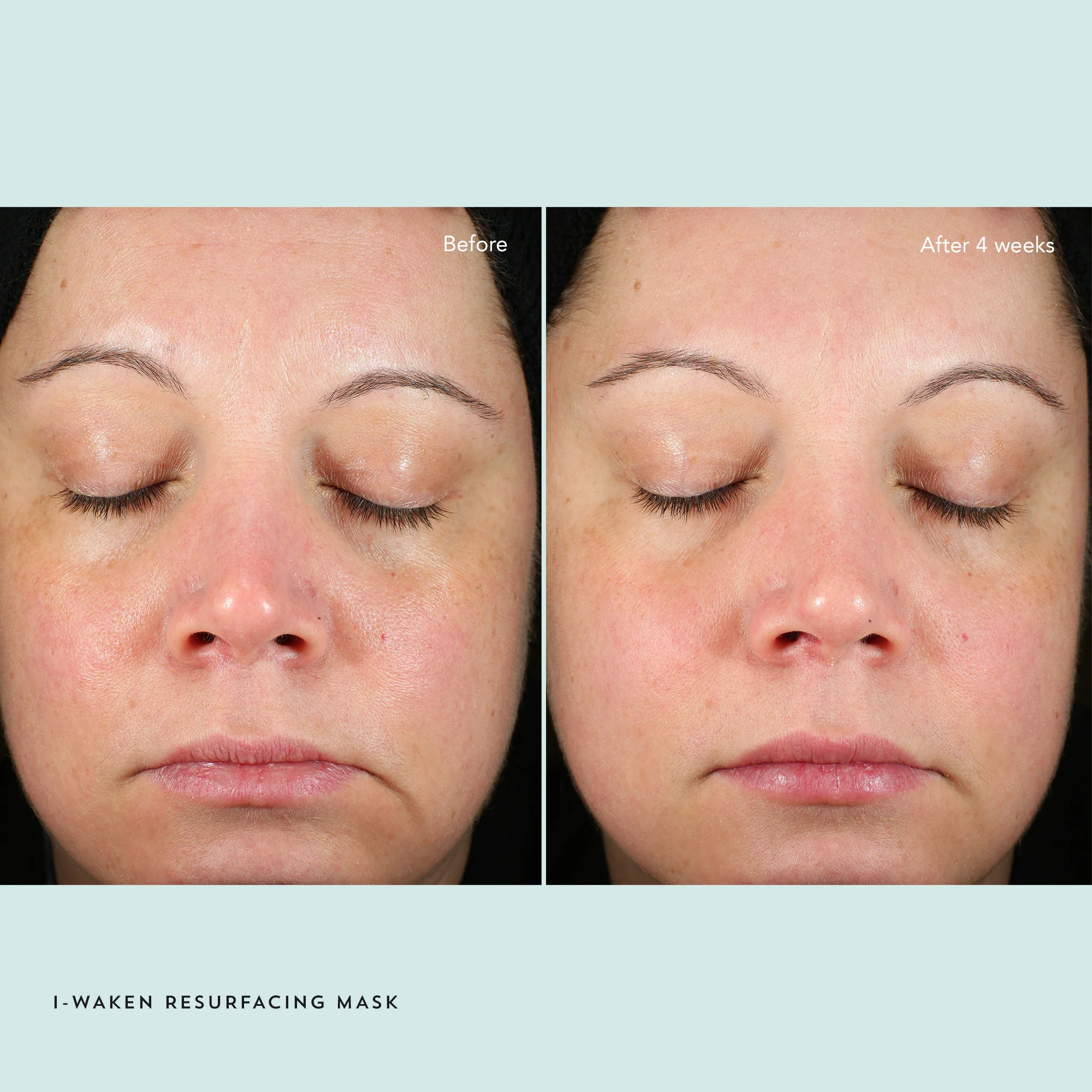 I-Waken Resurfacing Mask 5 I-Waken Resurfacing Mask