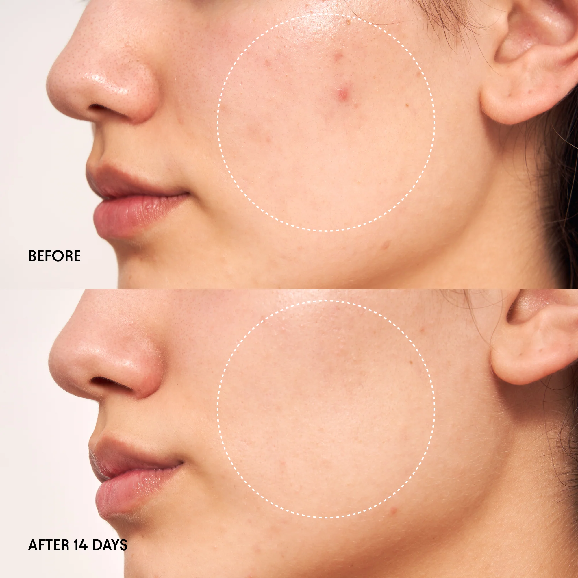 Wild Huckleberry Radiance Recovery Peel 2 Wild Huckleberry Radiance Recovery Peel