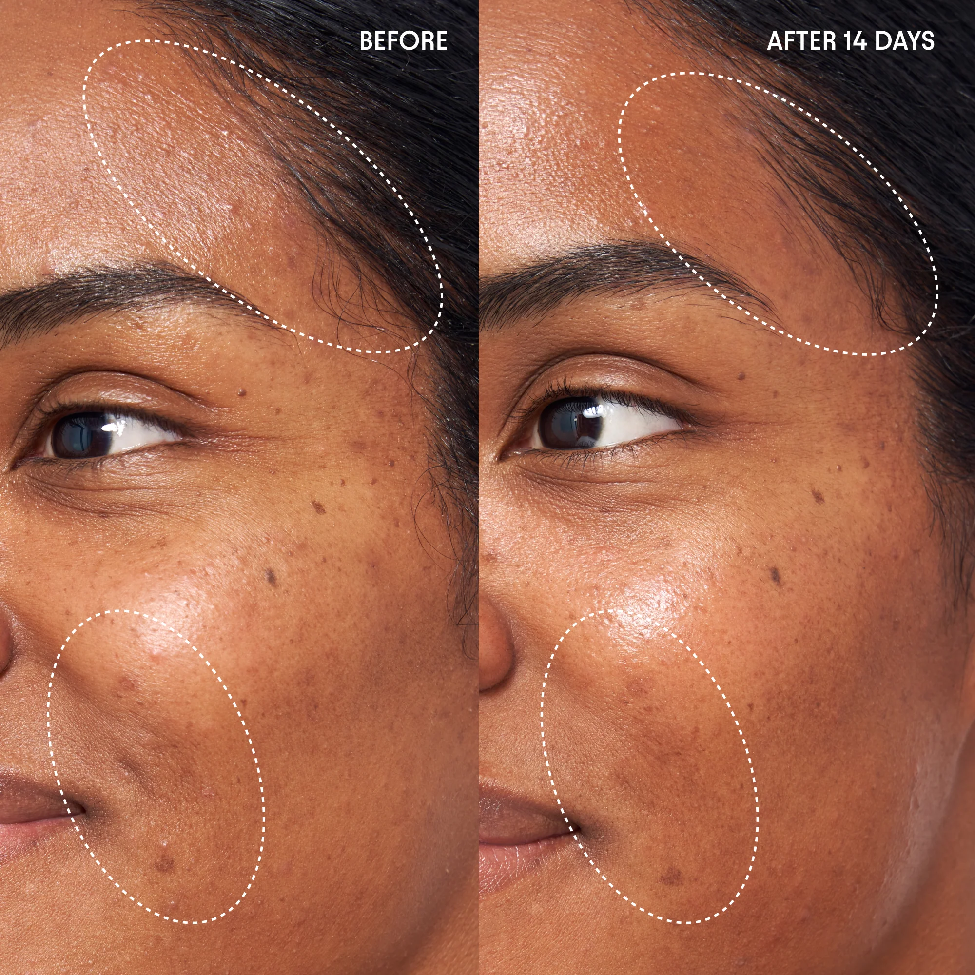 Wild Huckleberry Radiance Recovery Peel 3 Wild Huckleberry Radiance Recovery Peel